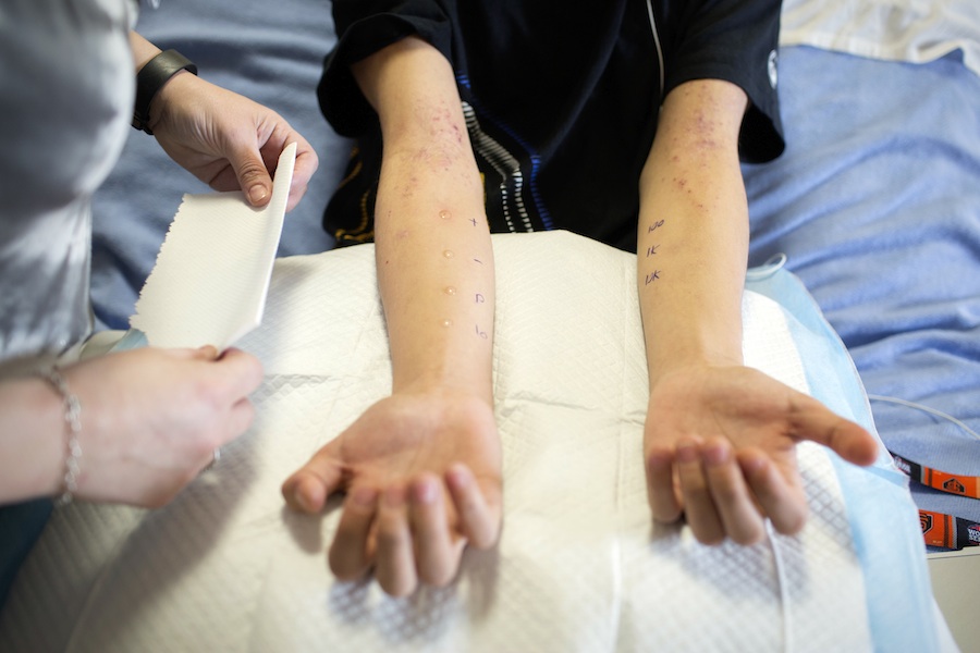 Steven Hom endures a skin test as part of a clinical trial that is designed to desensitize his immune system to his severe peanut allergy with an immunotherapy patch at El Camino Hospital in Mountain View, Calif. Photo by Alison Yin. Photos by Alison Yin